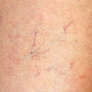 picture showing spider veins of woman receiving sclerotherapy in owasso to treat spider veins