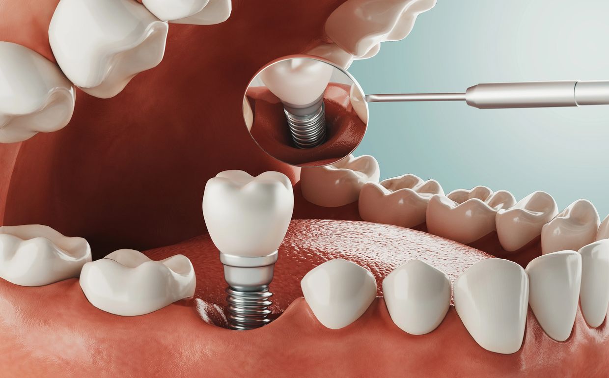 Dental Implant model