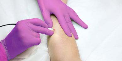 Cherry angioma successfully removed with minimal downtime.