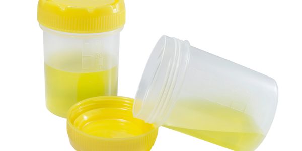 Two urine sample containers with yellow lids, one open and one closed.