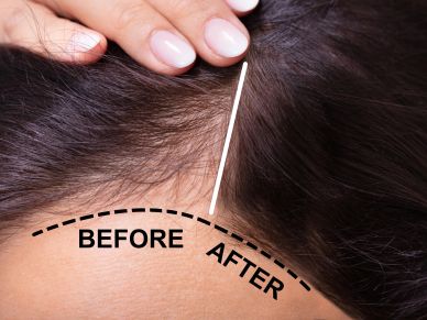 Close-up of scalp showing hair density before and after treatment.