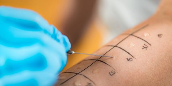 A skin allergy test with numbered markings and a needle.