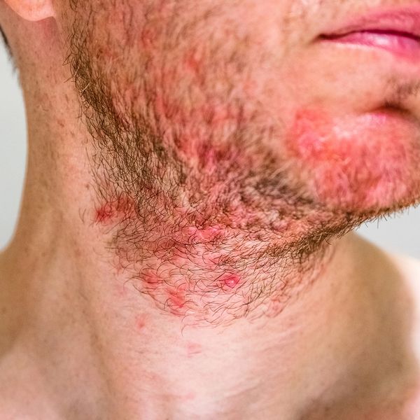 Irritated, red, and inflamed skin rash on a man's neck and face.