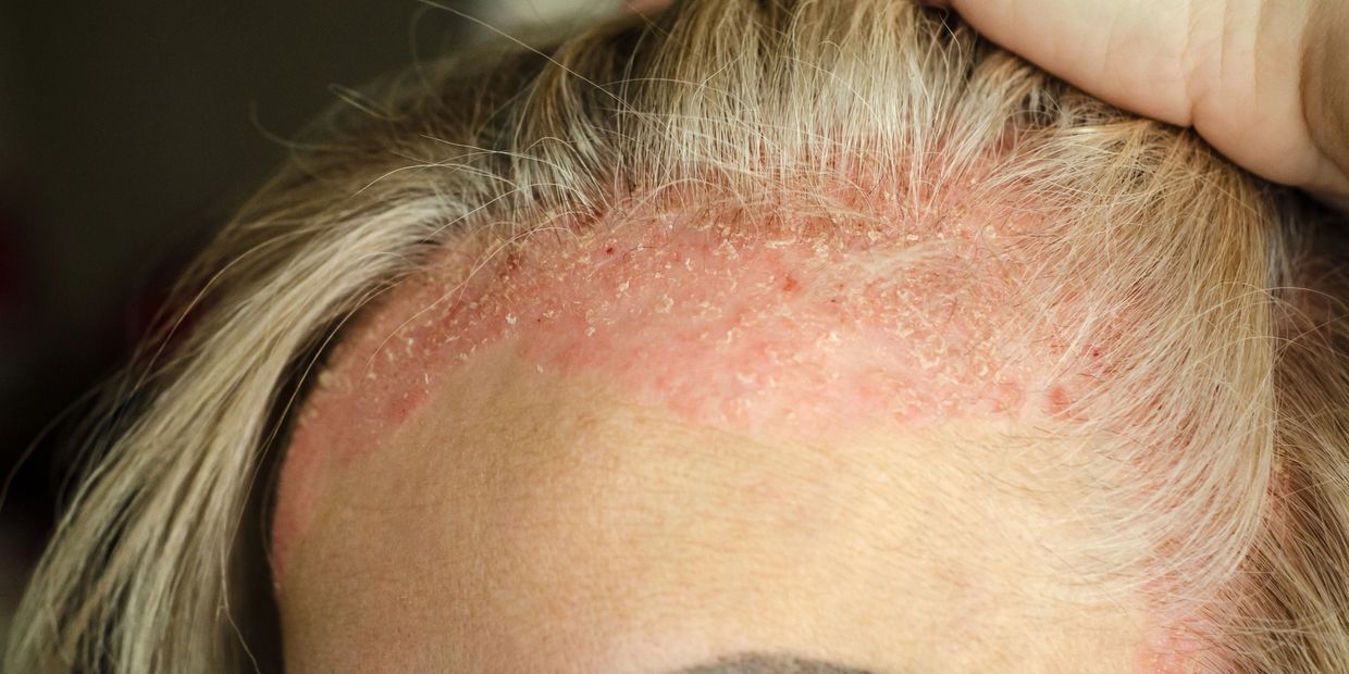 Red, flaky skin on a person's forehead and hairline.