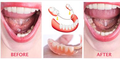 Before after Crowns and Bridges