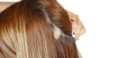Close-up of a woman showing a patch of hair loss on her scalp.