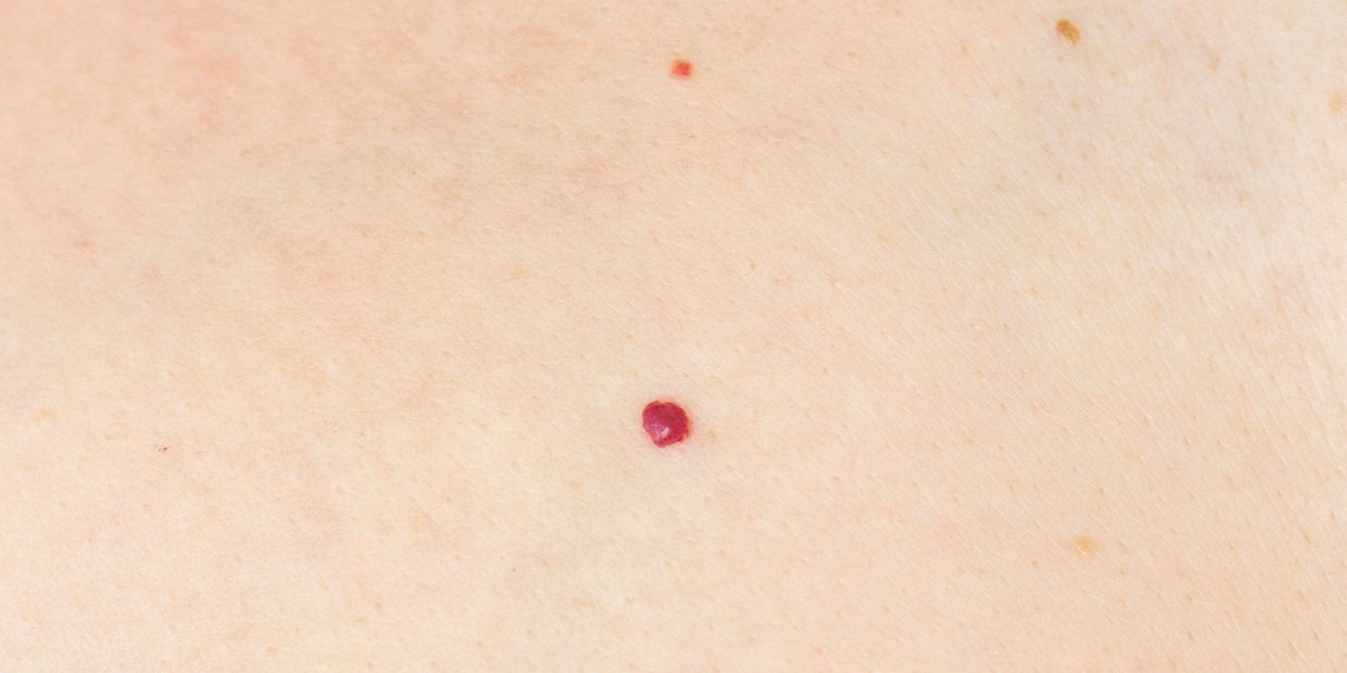 Instant Cherry angiomas/cherry spot removal, hawarden, Deeside, Chester, wirral