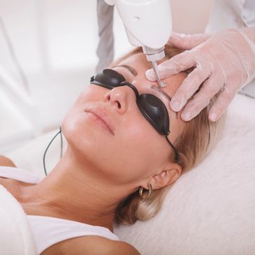 Woman receiving laser skin treatment on forehead while wearing protective eyewear.