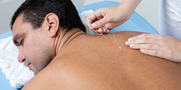 Acupuncture on back, Encino, California, the valley, 818, 91316, holistic healing, wellness