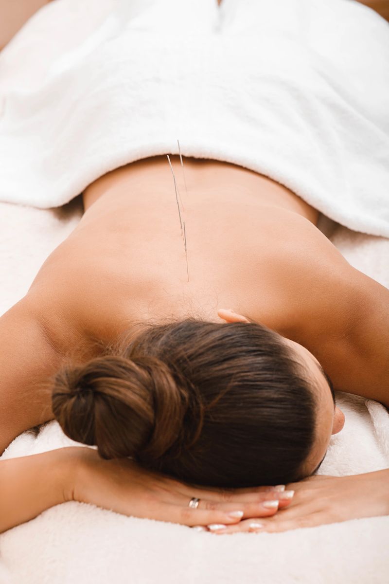 Acupuncture treatment of body. Needles along the spine of a woman in an acupuncture clinic.