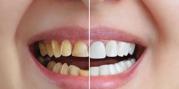 Split image patient smiling with small yellow teeth on the left image and bright white teeth on the 