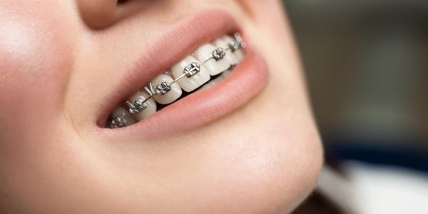 Braces at first impressions dental & implant clinic