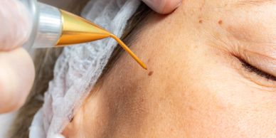 Close-up of mole removal on skin.
