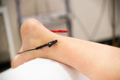 Electrodes attached to a person's ankle.