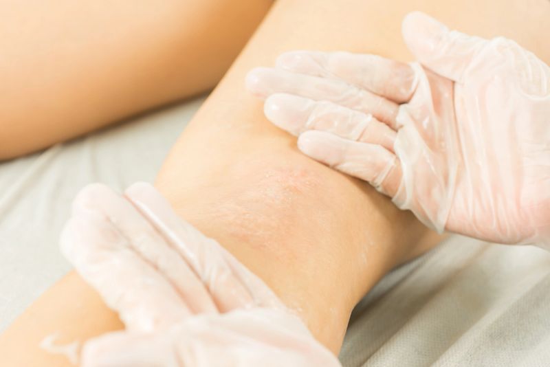 Scar camouflage therapy with rotative machine