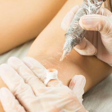 Paramedical tattoo for stretch marks in Atlantic Beach & Jacksonville, FL. 