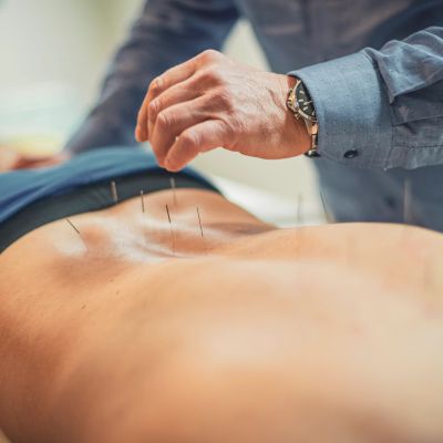 Practitioner performing acupuncture on a patient's back.