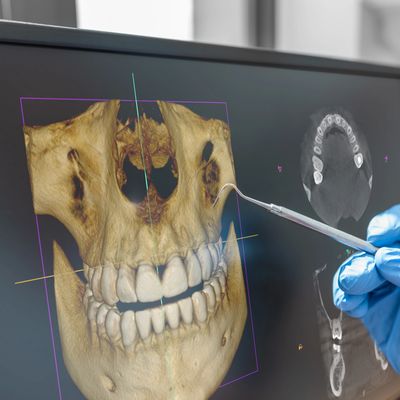 3D X-Ray of a patient on a computer monitor. 