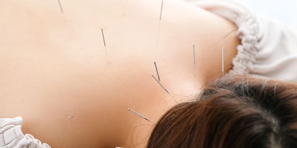 Acupuncture on back, Encino, California, the valley, 818, 91316, house call, concierge, home visit