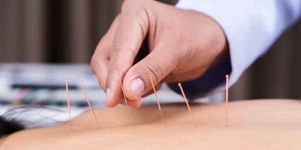 Hand performing acupuncture with needles on a person's back.