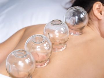 A young woman lies on her stomach, back exposed, four therapeutic cups sitting along her spine.