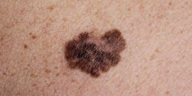 Skin Cancer