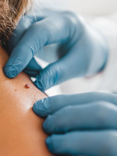 skin tag removal, flintshire, Deeside, Chester, north Wales, wirral