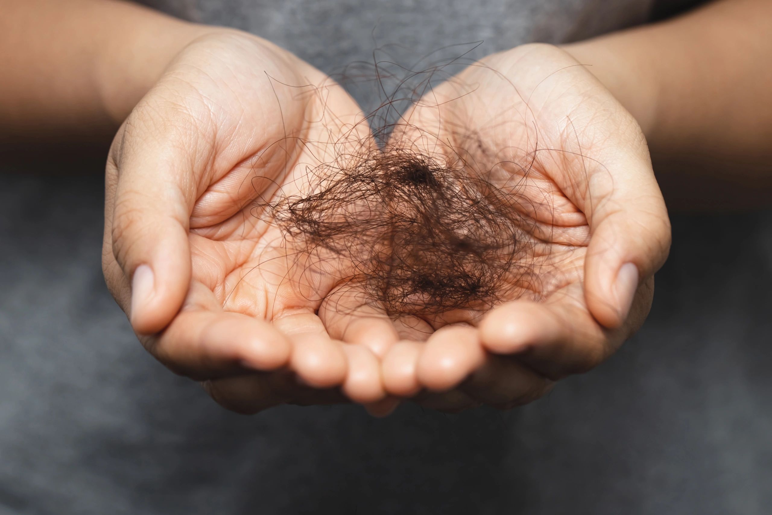 Hands holding a clump of fallen hair, symbolizing hair loss.