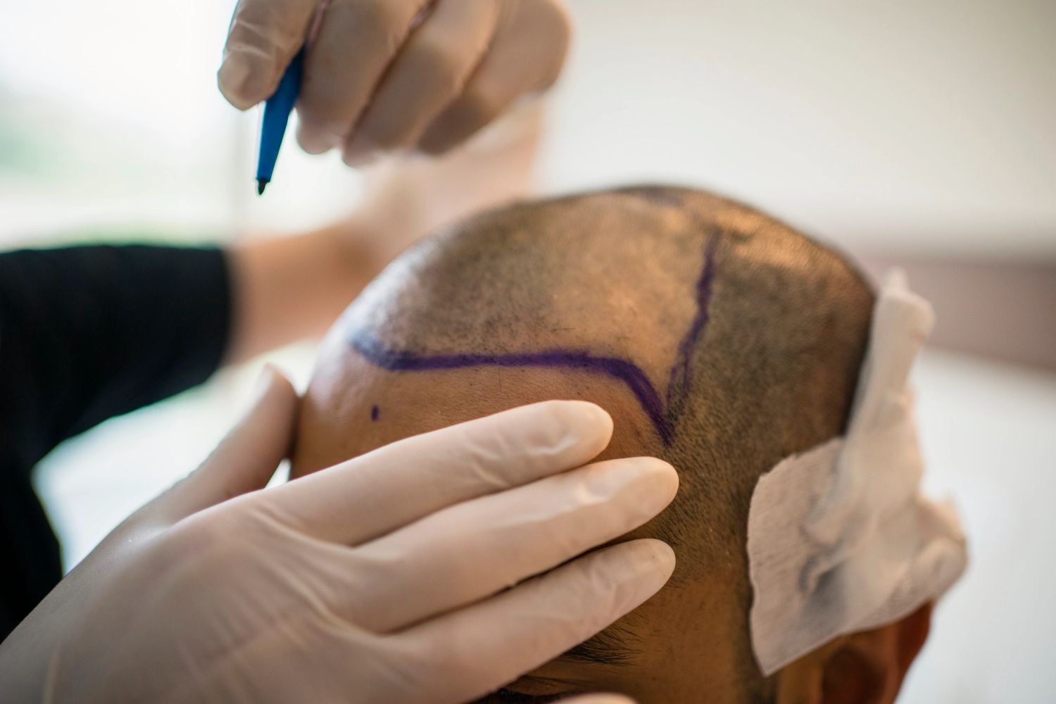 Doctor marking hairline for a hair transplant procedure.