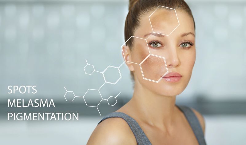 Dark spots, freckles,hyperpigmentation(melasma or chloasma)
