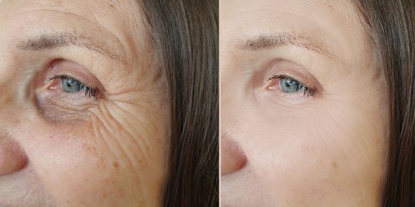 Side profile of womans face heavy crows feet wrinkles on left image. Same woman on right smooth face