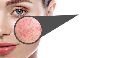 advanced electrolysis for instant removal of red veins 