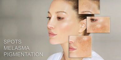 Close-up of a woman with highlighted skin spots, melasma, and pigmentation areas.