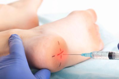 Injection being administered to a marked area on the heel.