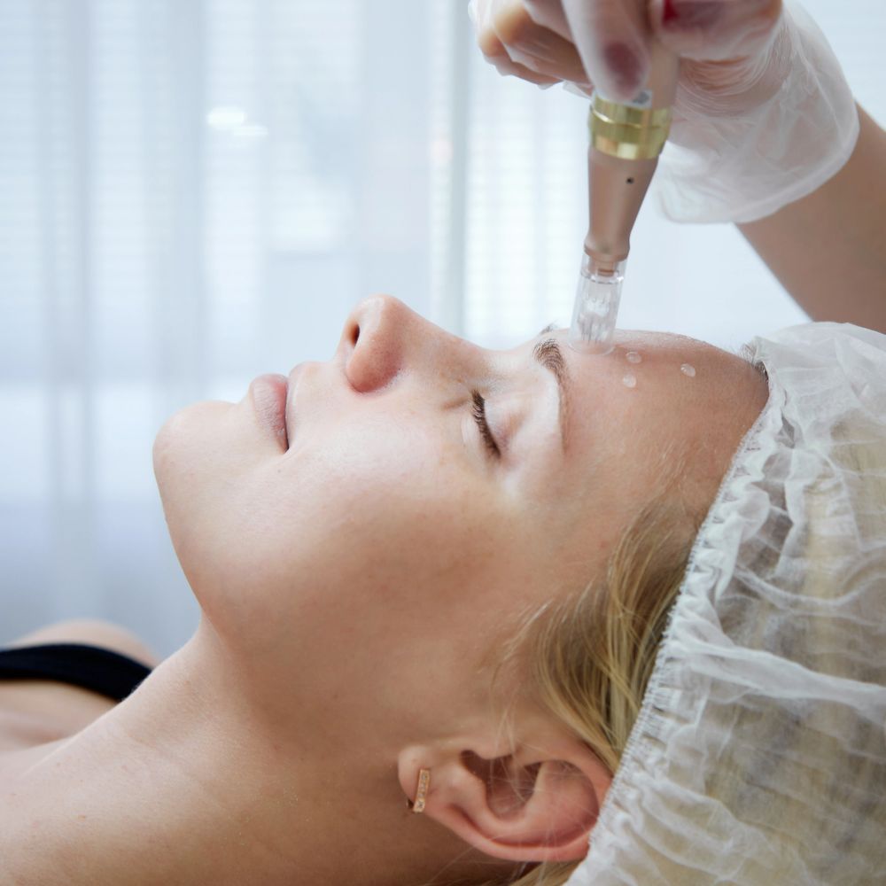 Woman receiving a microneedling facial treatment on her forehead.