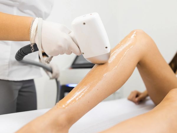 Eliminación de vello corporal con Láser Diodo en Castelldefels