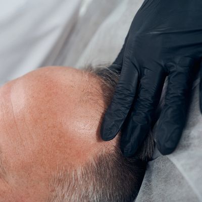 Scalp micropigmentation removal with Astanza Duality laser on the Treasure Coast