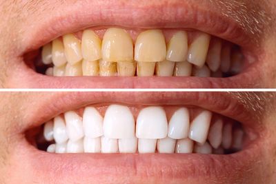 Comparison of a man's teeth before and after whitening treatment