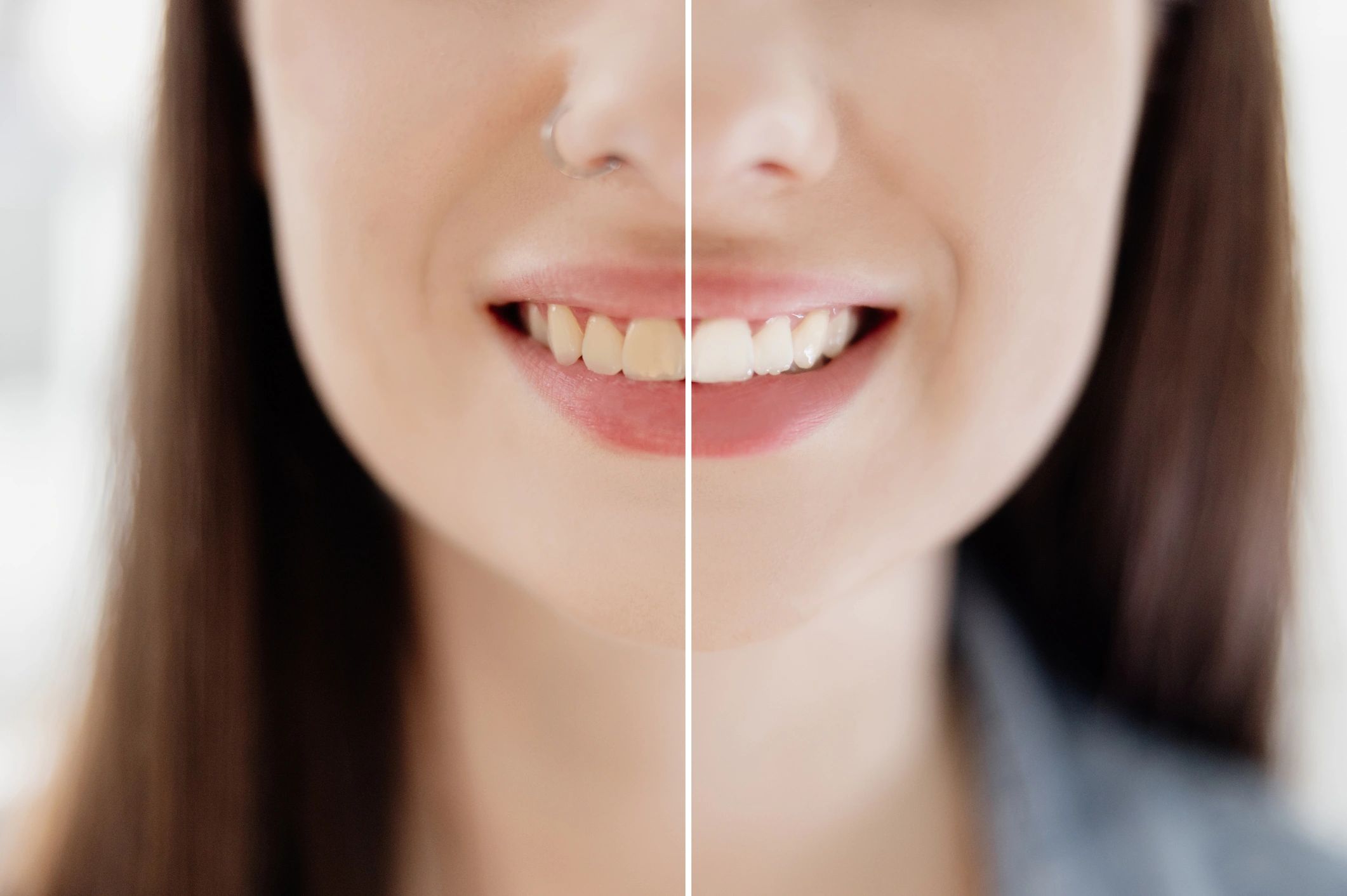 Close-up of a woman's smile showing before and after teeth whitening.