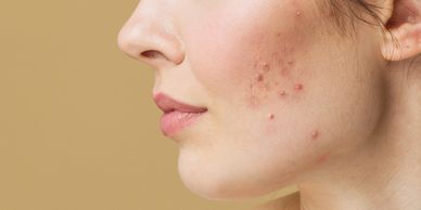 Close-up of a woman's cheek with acne and blemishes.