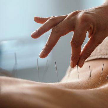 Hand adjusting acupuncture needles on a person's back during treatment.