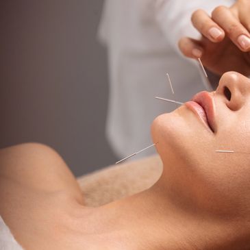 Woman receiving acupuncture on her face and neck for relaxation and wellness.