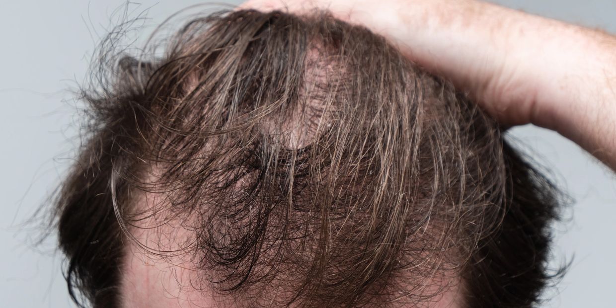 Brisbane's number 1 hair loss treatment using medical grade exosomes and advanced dermal delivery.