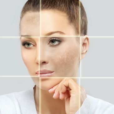 woman with melasma receives medspa treatments in Owasso at Pathway Health & Beauty