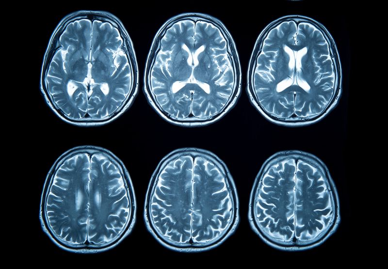 Brain stroke x-ray;MRI of the blood vessels in the brain and cerebrovascular disease or hemorrhagic stroke.