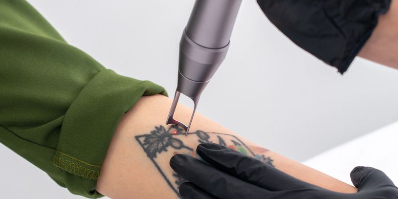 Close up image of forearm with colorful tattoo, laser machine device pointing at it for removal.