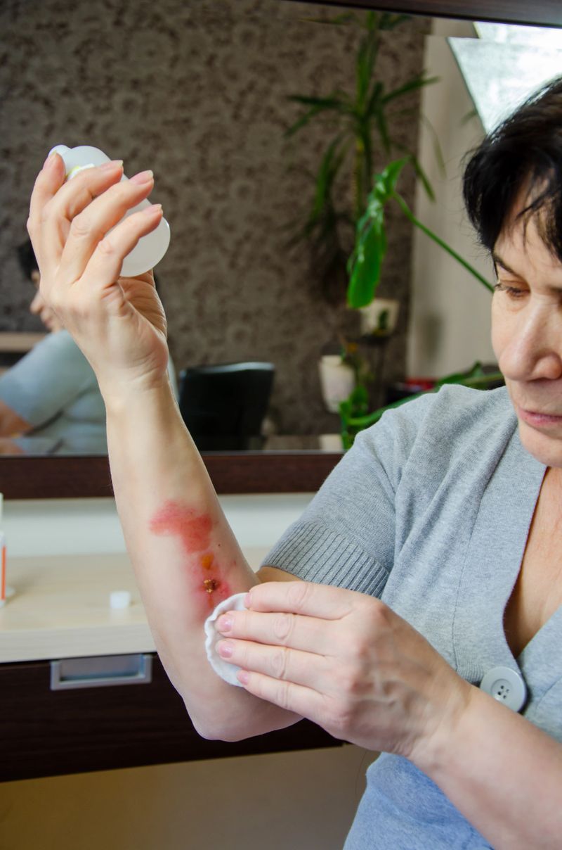A woman treats a burn wound by applying an antiseptic to the skin. Wound treatment, scar removal, skin care, burn recovery.