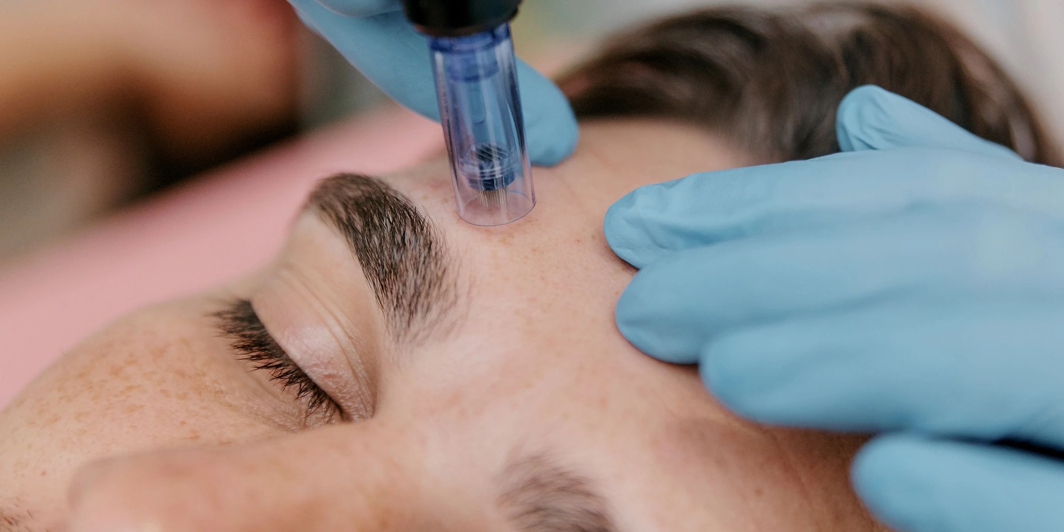 Microneedling procedure on forehead.