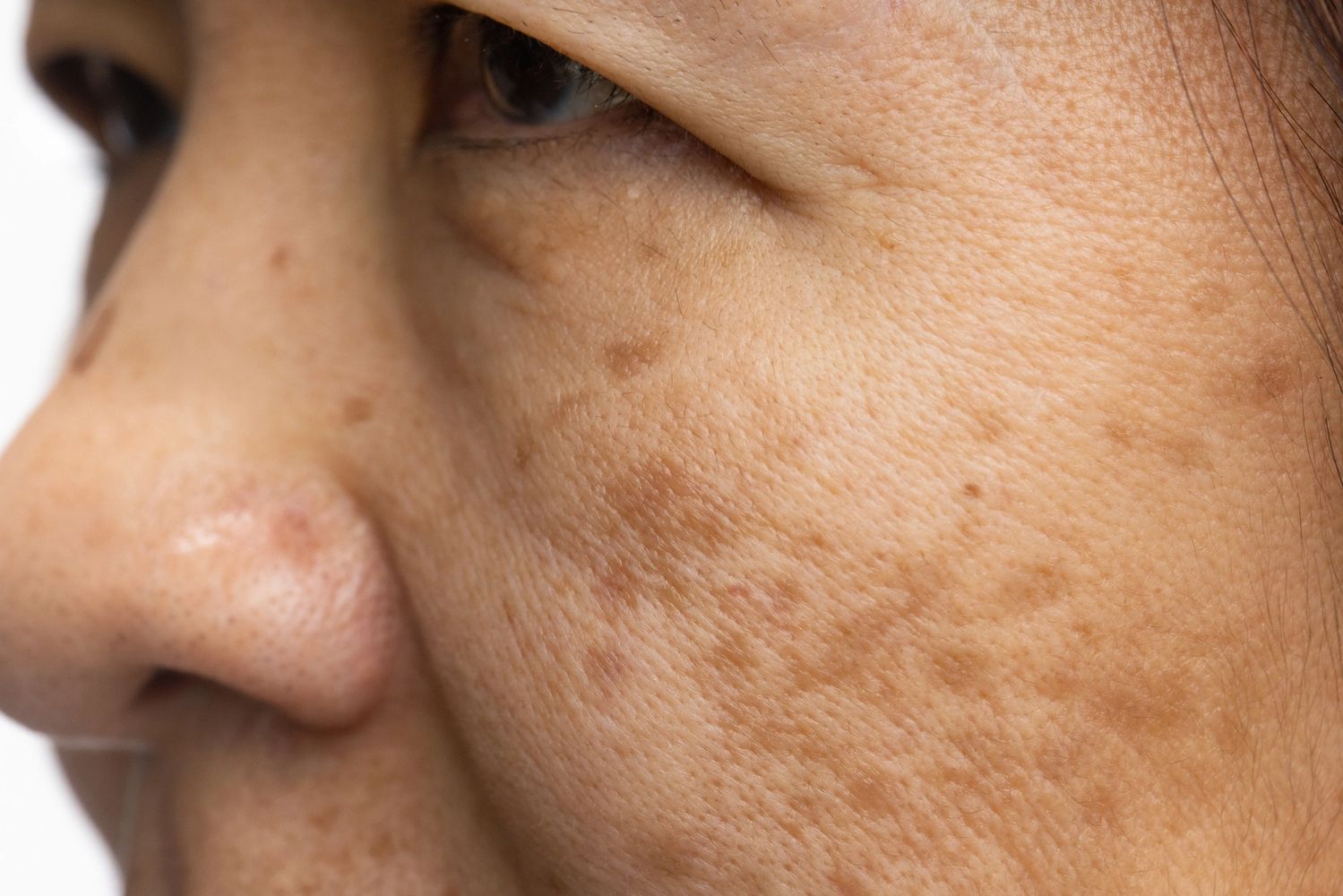 Melasma over Cheeks