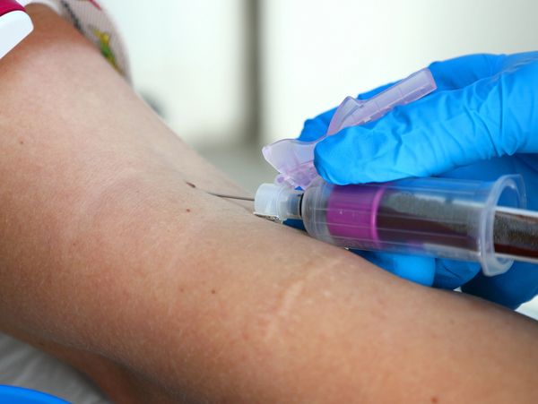 Therapeutic Phlebotomy